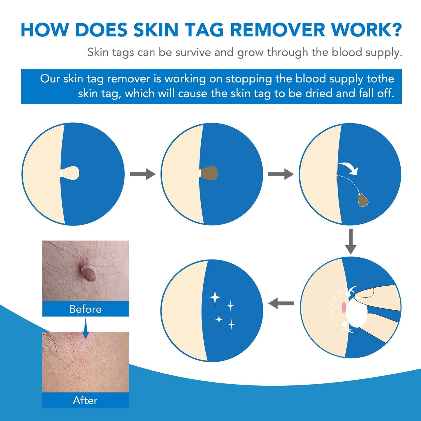 Skin Tag Removal Kit Home Mole Wart Puntos Negros Remover Equipment Micro Skin Tag Removeal Tool Easy To Clean Skin Care Tool